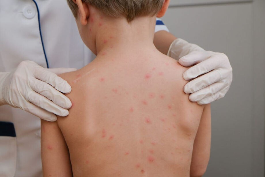 Meningite pode ser prevenida com vacinação, destaca coordenadora da Vigilância Epidemiológica