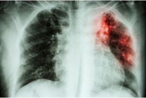 Brasil registra mais de 80 mil novos casos de tuberculose em 2023, aponta boletim epidemiológico