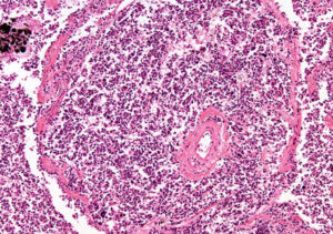 Câncer silencioso: tipos que quase não apresentam sintomas