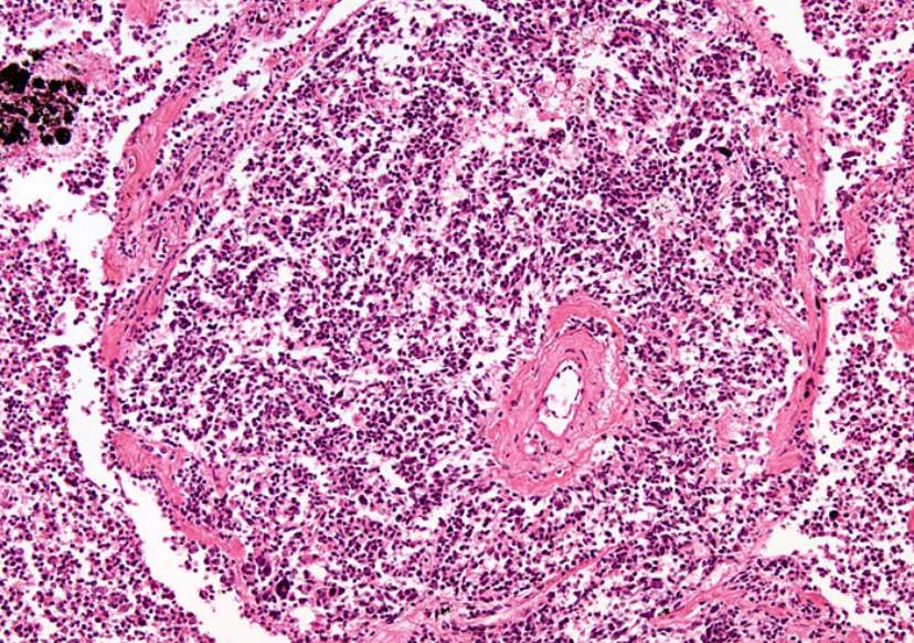 Câncer silencioso: tipos que quase não apresentam sintomas